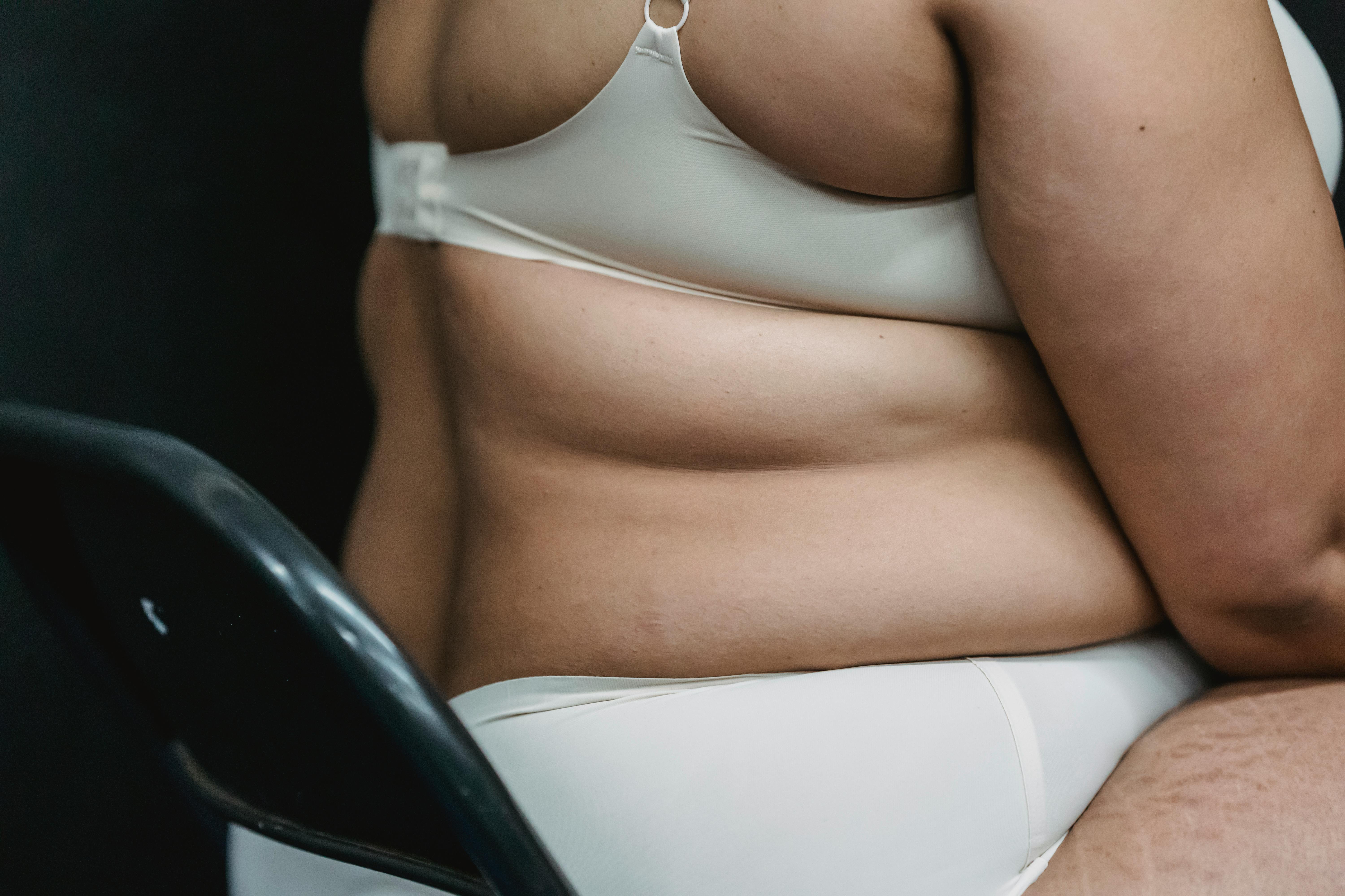 C&oacute;mo manejar la piel fl&aacute;cida despu&eacute;s de la p&eacute;rdida de peso